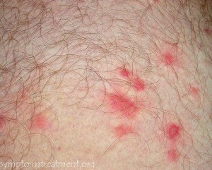 Chiggers (Jiggers / Red Bugs) Treatment – How to Get Rid ...